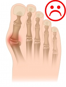 Forefoot_running_prevents_bunions_growing_Bretta_riches_run_forefoot