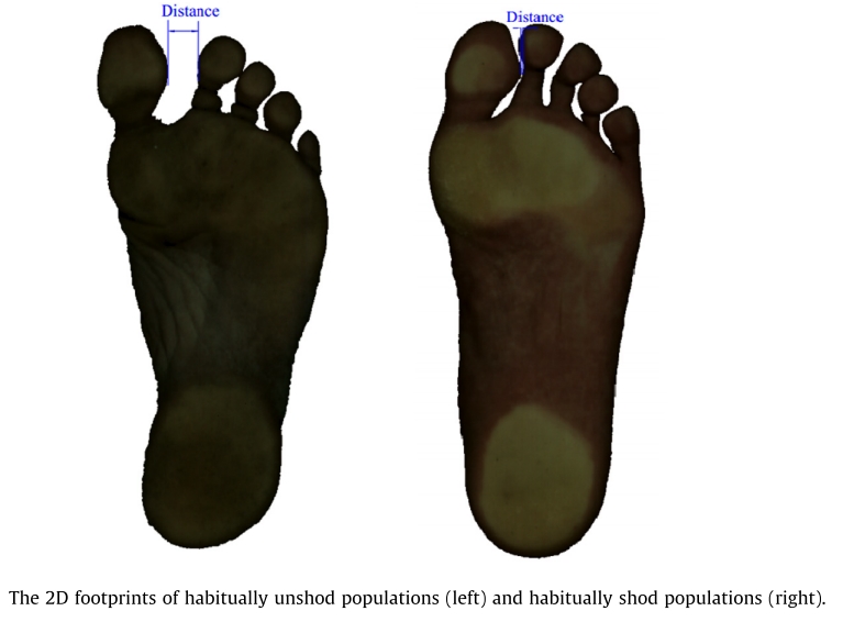 Barefoot Running Helps Bunion Symptoms Pain
