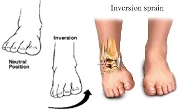 Ankle Joint Sprain From Forefoot Running