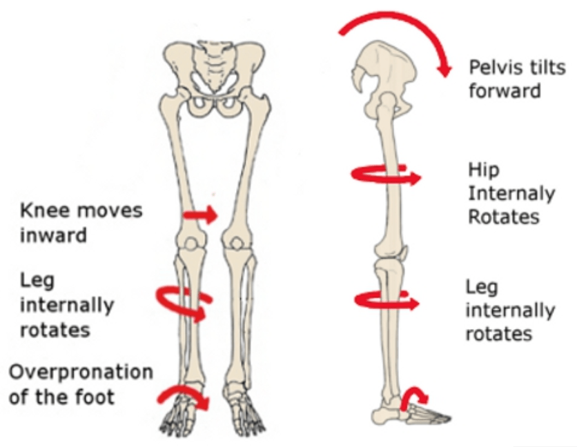 Foot Overpronation From Heel Striking Causes Hip Pain