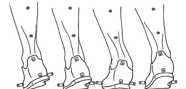 Forefoot Running May Prevent Overpronation
